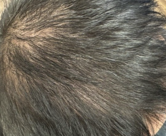 consulenza tricologica