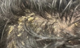 consulenza tricologica