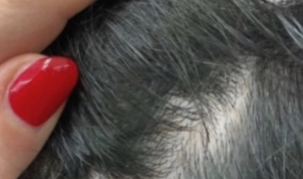 consulenza tricologica